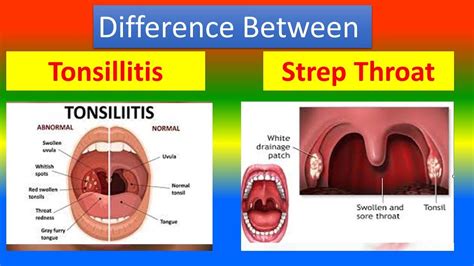 tonsillitis vs strep